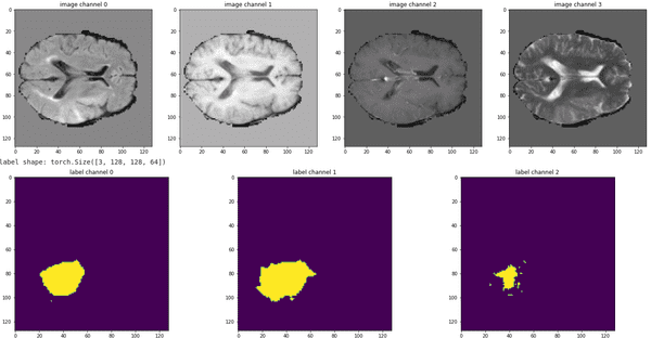 3D Medical image segmentation with transformers tutorial | AI Summer