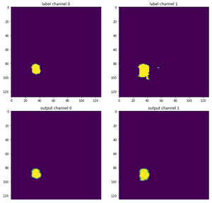 3D Medical image segmentation with transformers tutorial | AI Summer